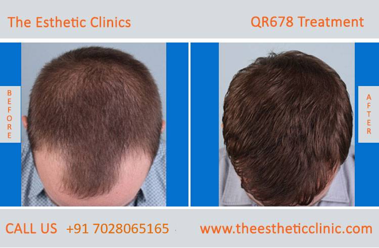 qr678 treatment, qr678 hair injection injection before after photos in mumbai india (4)